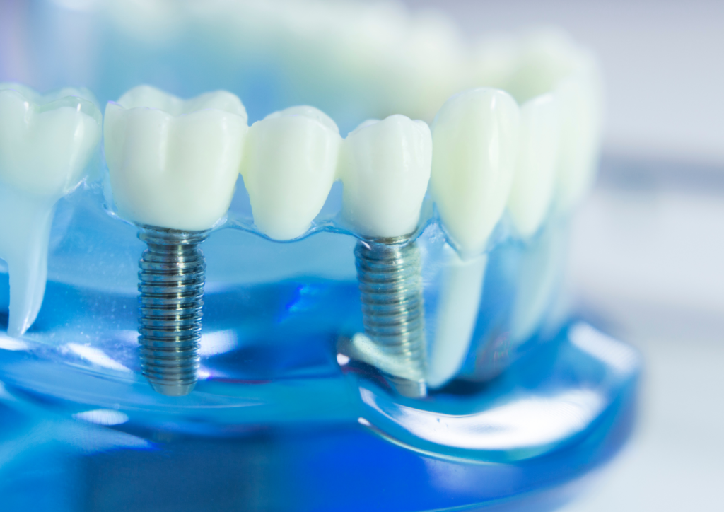 Implantes dentários